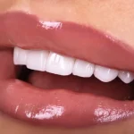 What To Expect After Dental Veneers