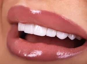 What To Expect After Dental Veneers