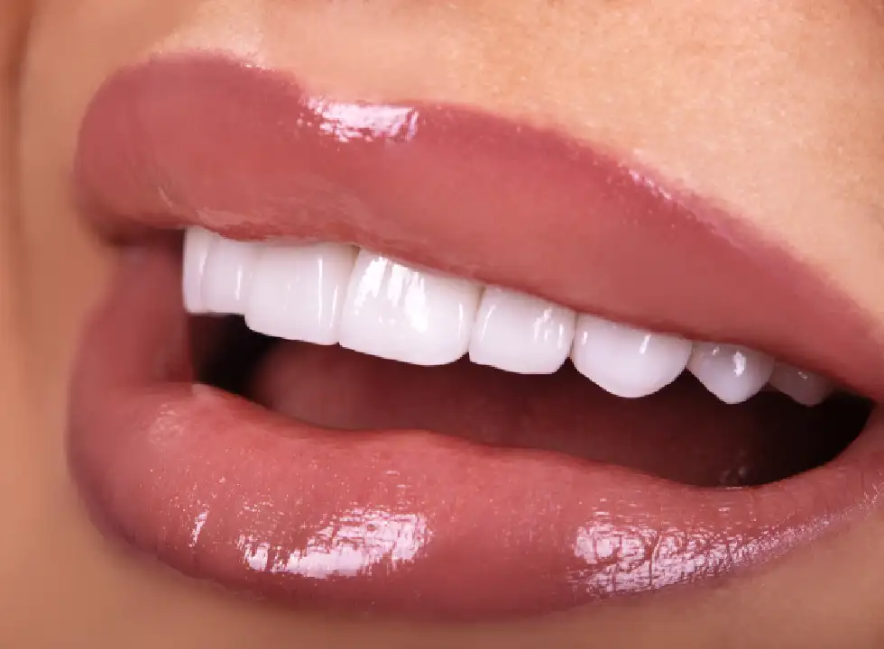 What To Expect After Dental Veneers
